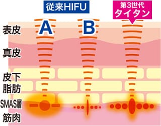 第3世代タイタンの特徴と効果